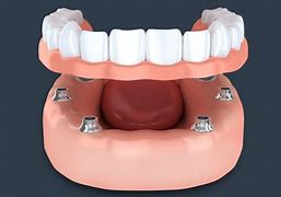 Your Prosthetic, Implant & Denture Dentist