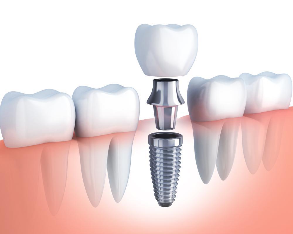 Is it worth going to turkey for dental implants