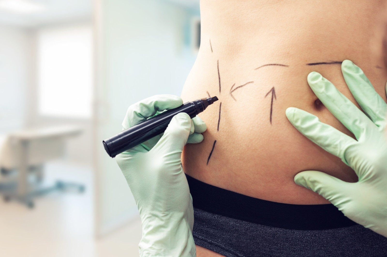 Breaking Down the Differences of Panniculectomy vs Abdominoplasty