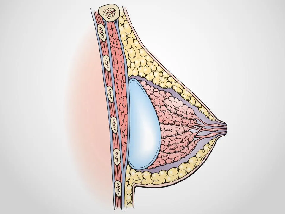 Breast Augmentation
