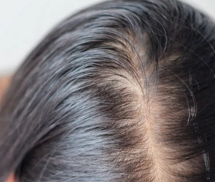 Hair Regrowth Treatments