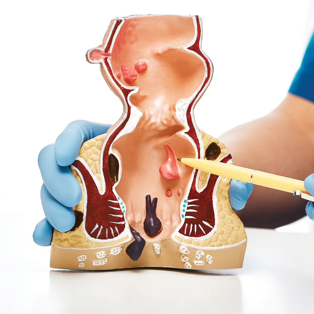 A Clear and Supportive Guide to Internal Hemorrhoid Treatment