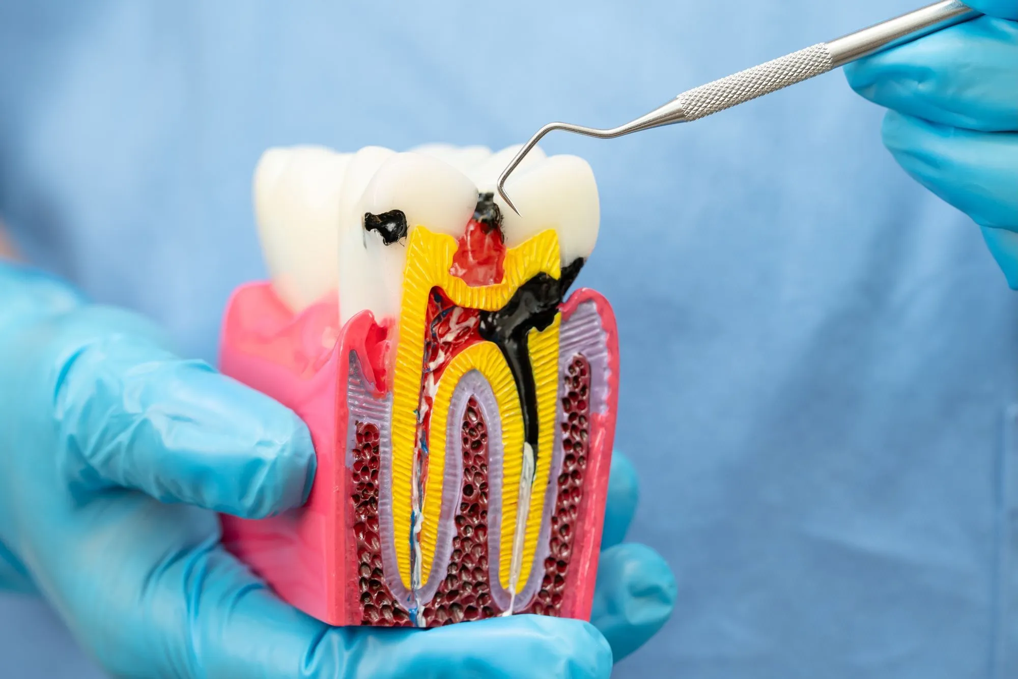 Root Canal Troubles? Here’s Why Retreatment Might Be Necessary