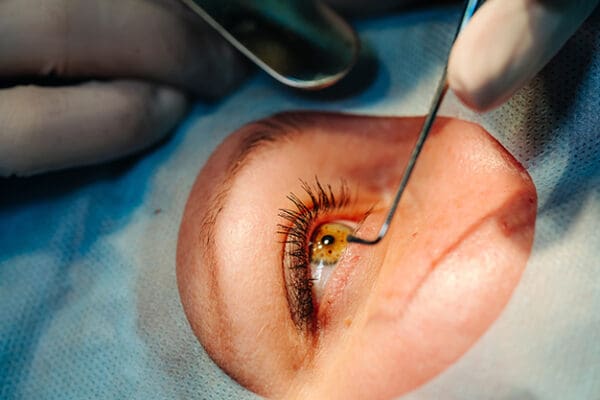 Comprehensive Guide to Lasik and Cataract Evaluations